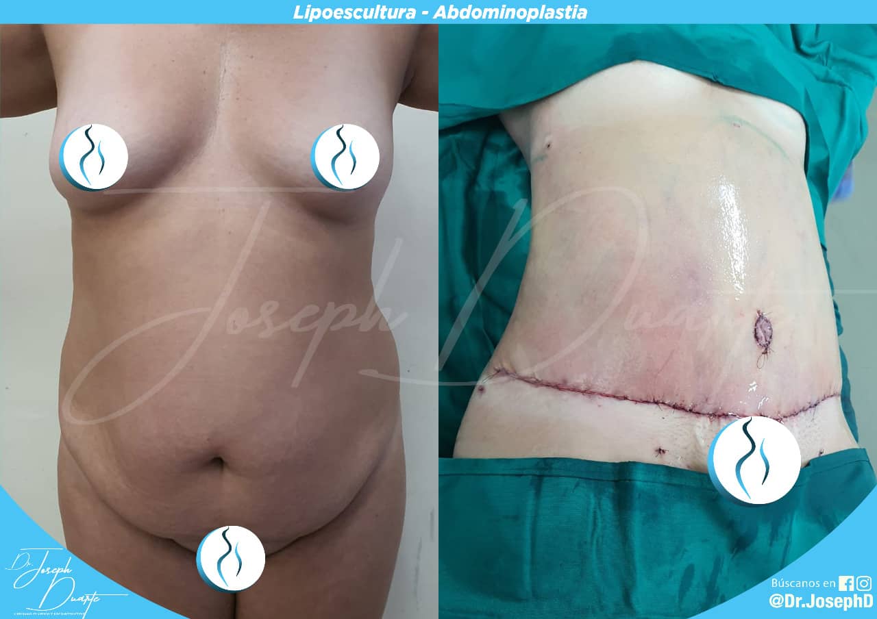 LIPO + ABDOMINOPLASTIA