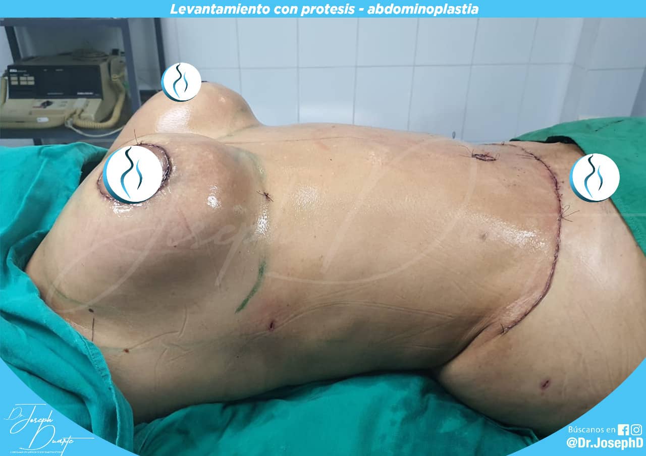 ABDOMINOPLASTIA + MAMAS