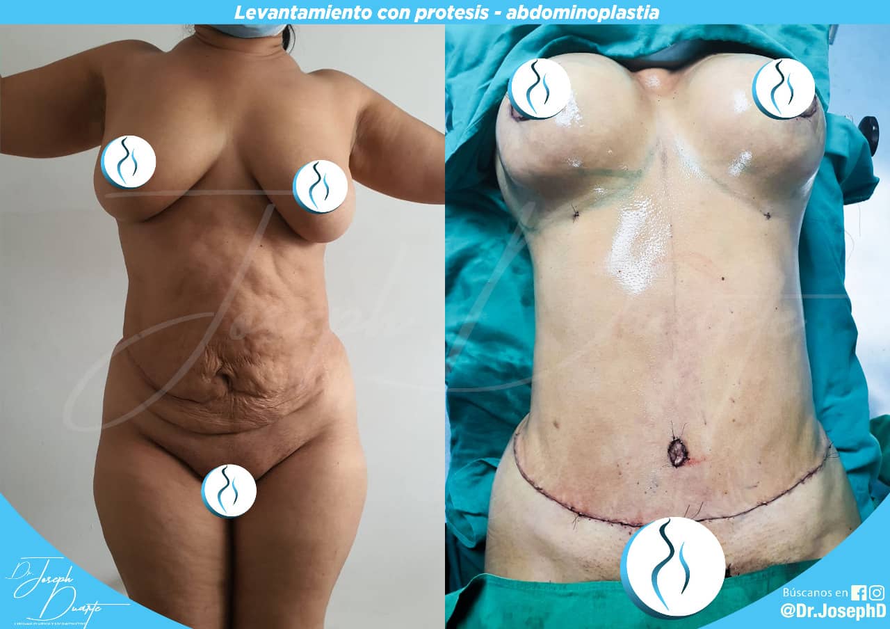 ABDOMINOPLASTIA + AUMENTO MAMARIO