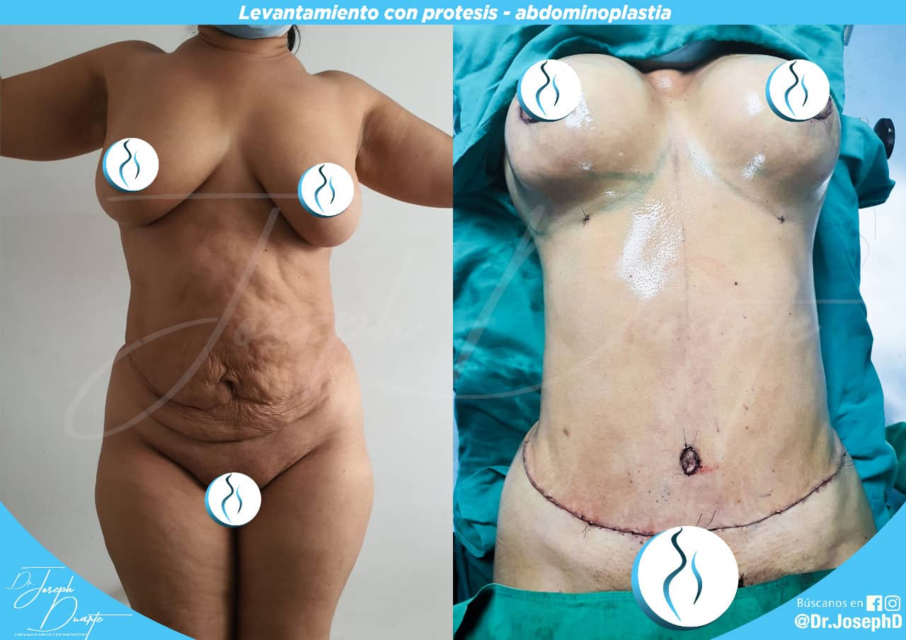 ABDOMINOPLASTIA