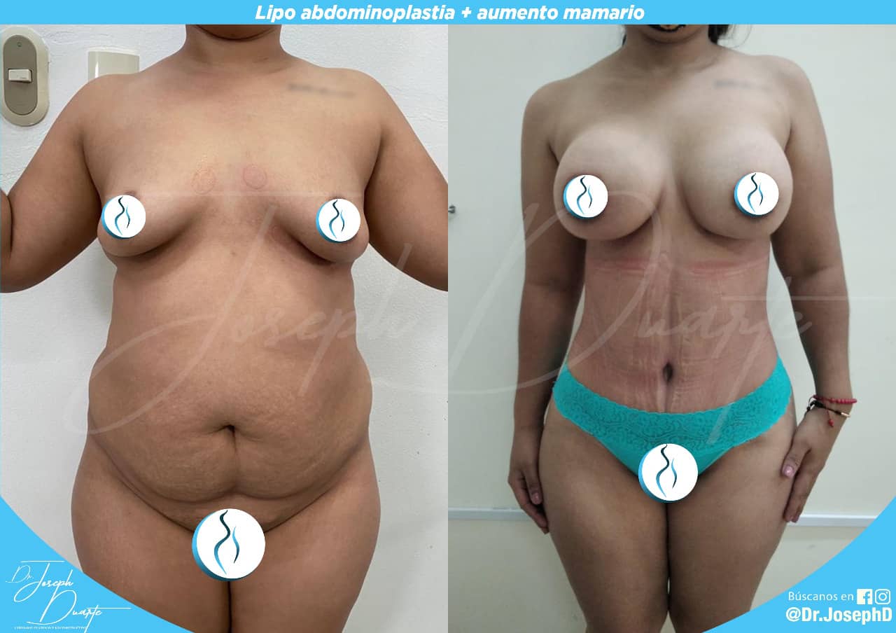 ABDOMINOPLASTIA + MAMAS