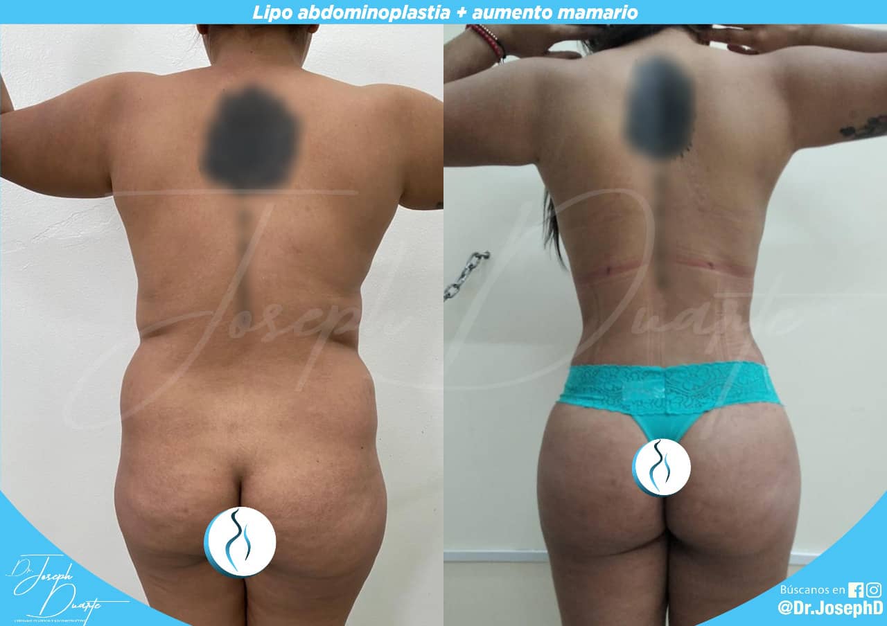 ABDOMINOPLASTIA + GLUTEOS