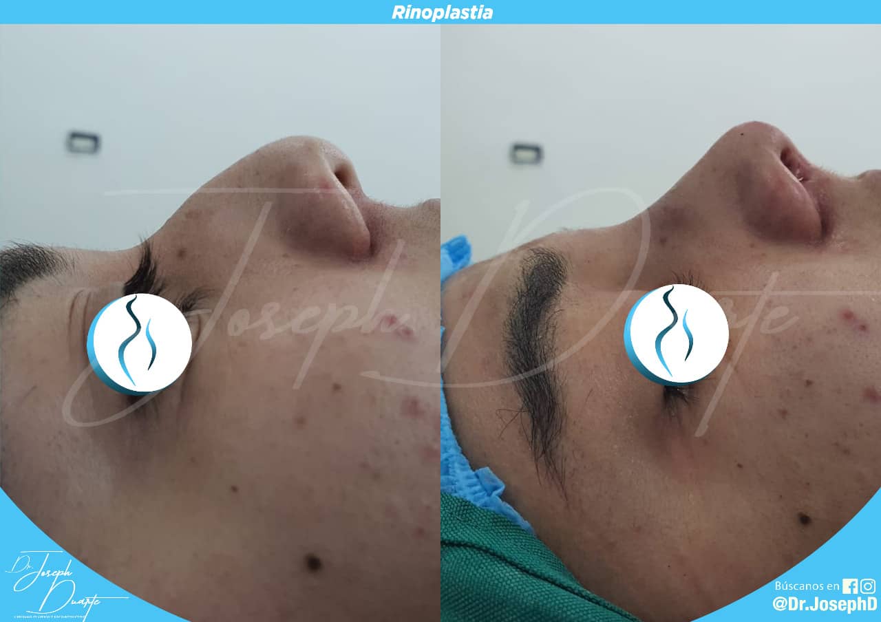 josephduarte_rinoplastia_11