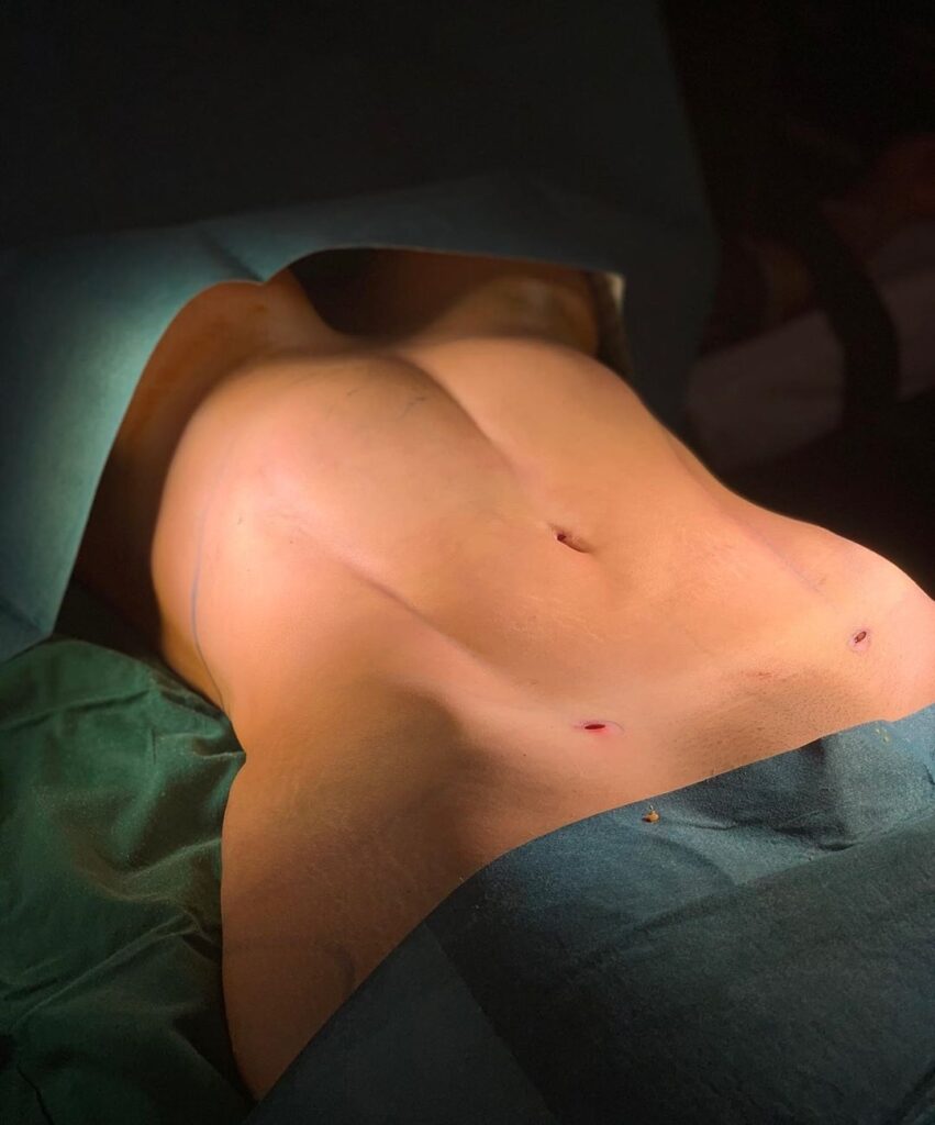 Lipoescultura Hd Dr Joseph Duarte