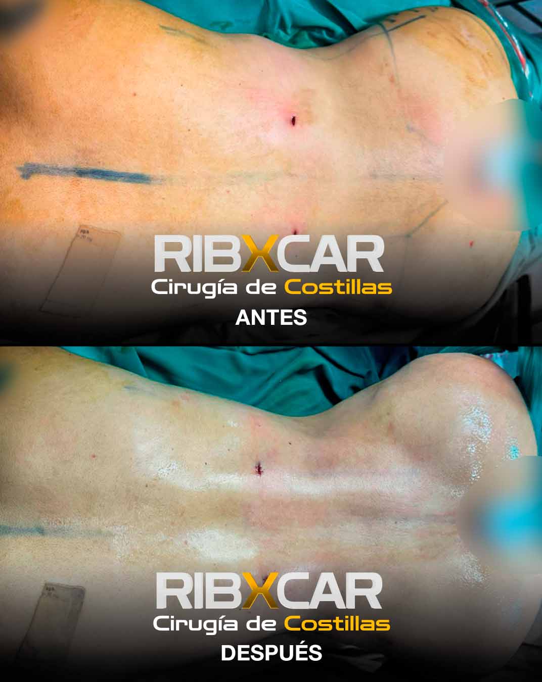REMODELACION COSTAL O CIRUGIA DE COSTILLAS Dr. JOSEPH DUARTE