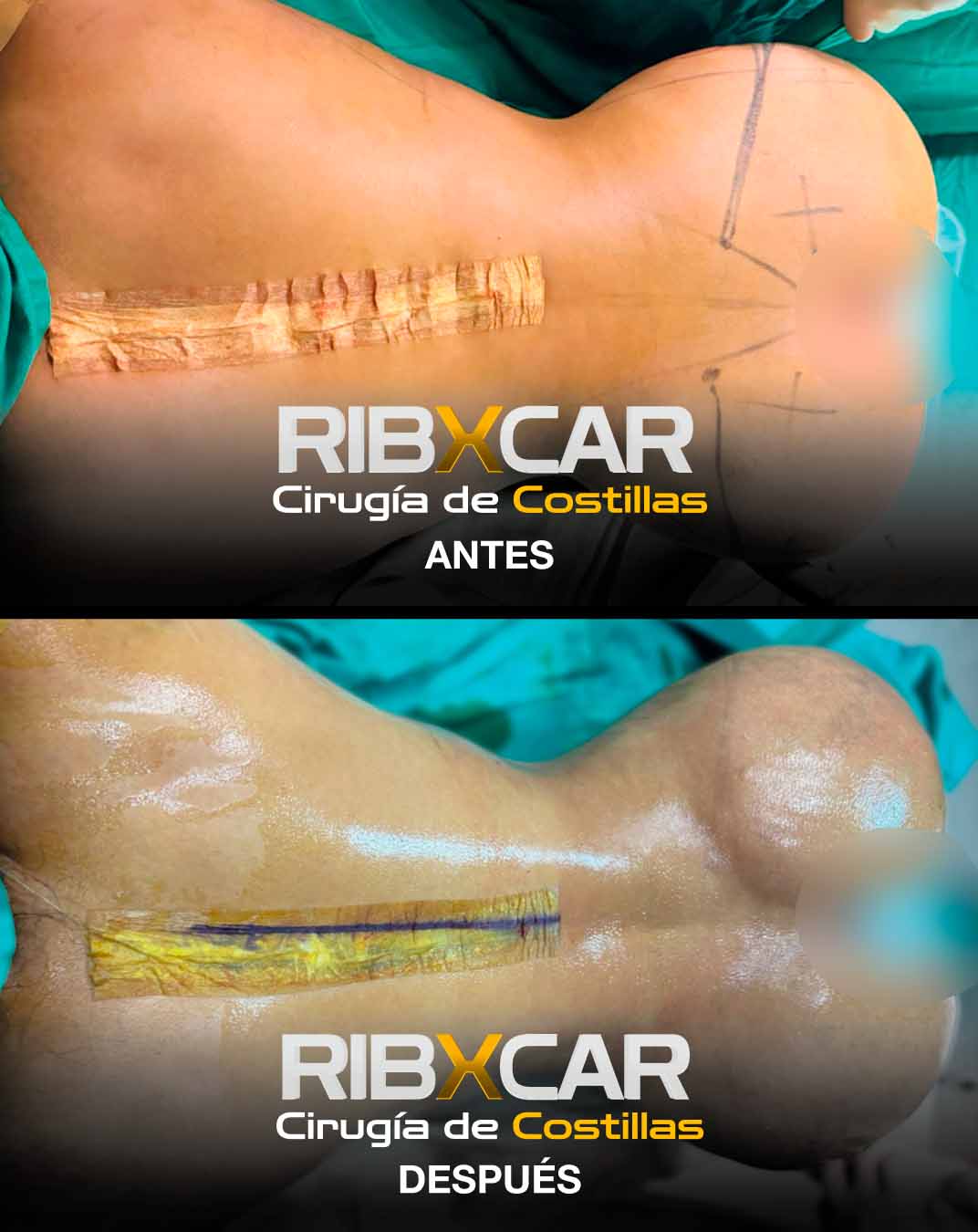REMODELACION COSTAL O CIRUGIA DE COSTILLAS Dr. JOSEPH DUARTE