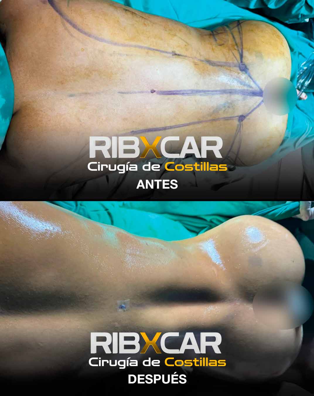 REMODELACION COSTAL O CIRUGIA DE COSTILLAS Dr. JOSEPH DUARTE