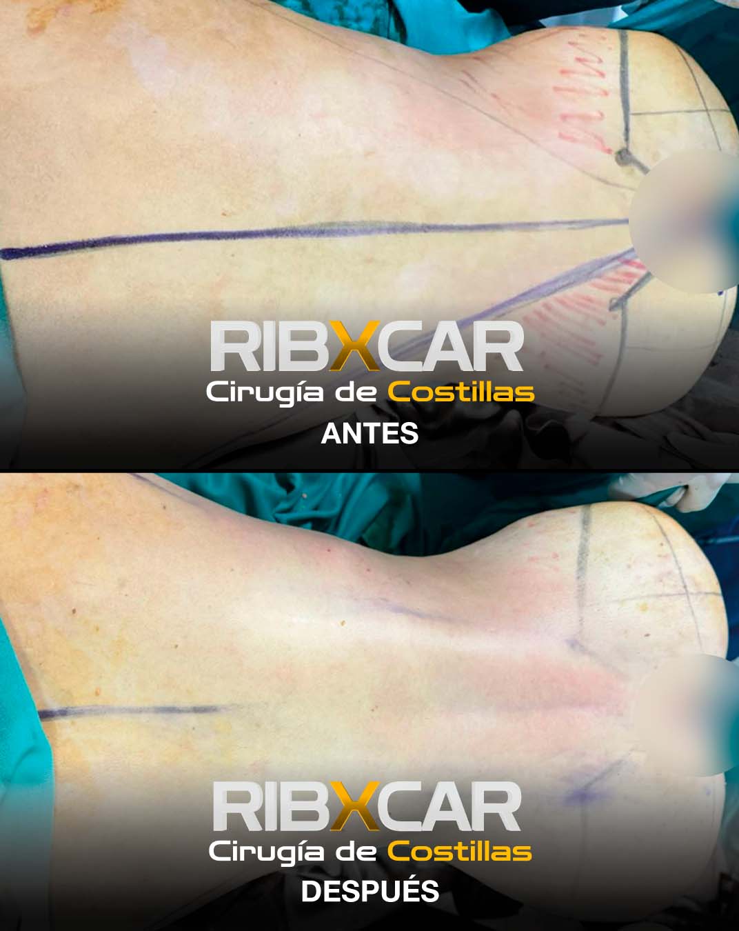 REMODELACION COSTAL O CIRUGIA DE COSTILLAS Dr. JOSEPH DUARTE