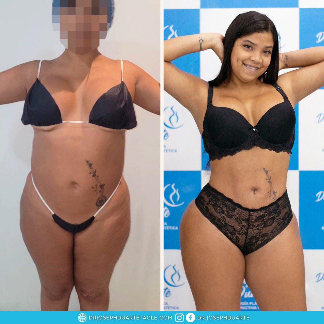 Resultado Lipoescultura Dr. Joseph Duarte