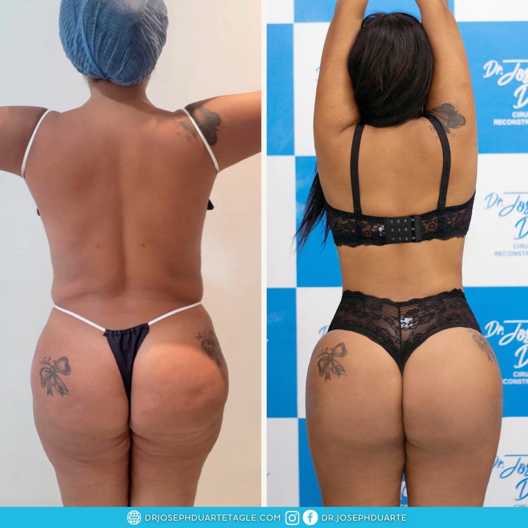 Resultado Lipoescultura Dr. Joseph Duarte