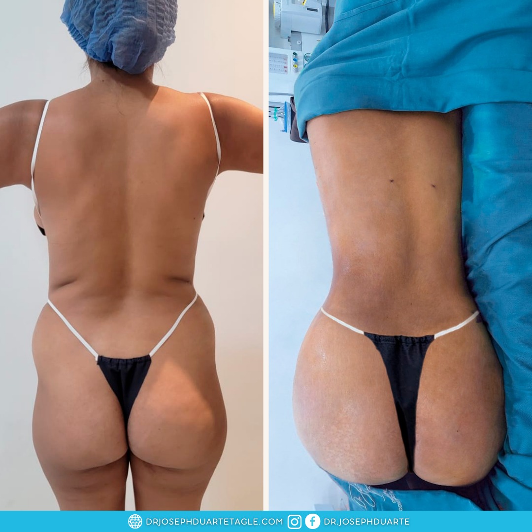 Resultado Lipoescultura Dr. Joseph Duarte