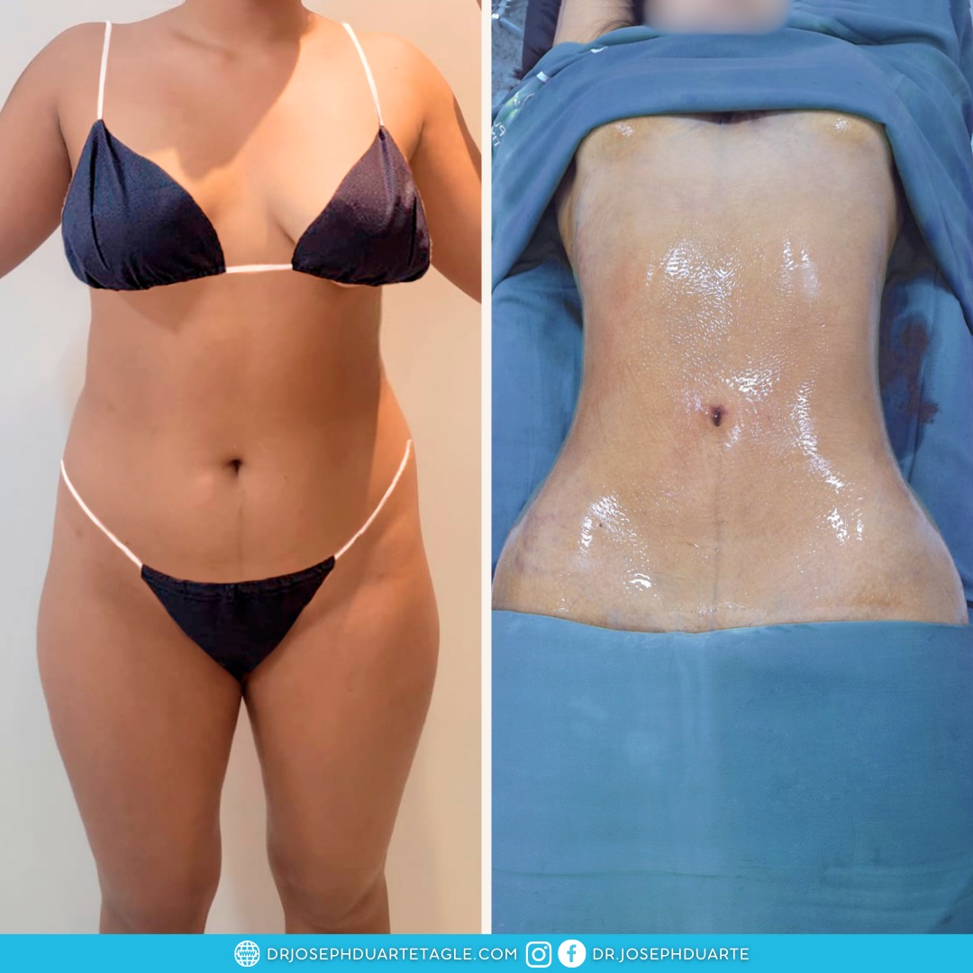 Resultado Lipoescultura Dr. Joseph Duarte
