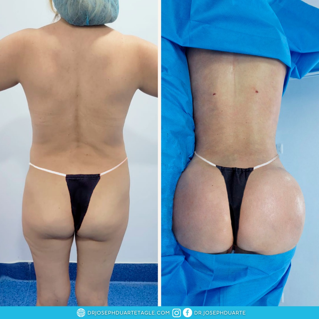 Resultado Lipoescultura Dr. Joseph Duarte