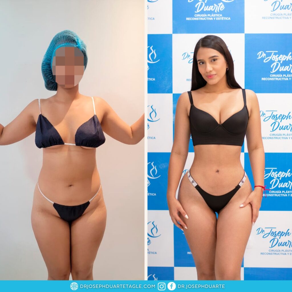 Resultado Lipoescultura Dr. Joseph Duarte