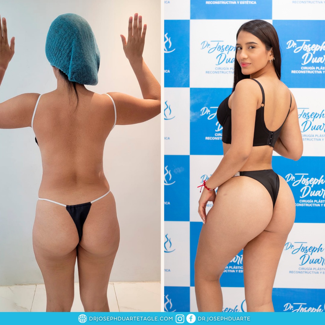 Resultado Lipoescultura Dr. Joseph Duarte