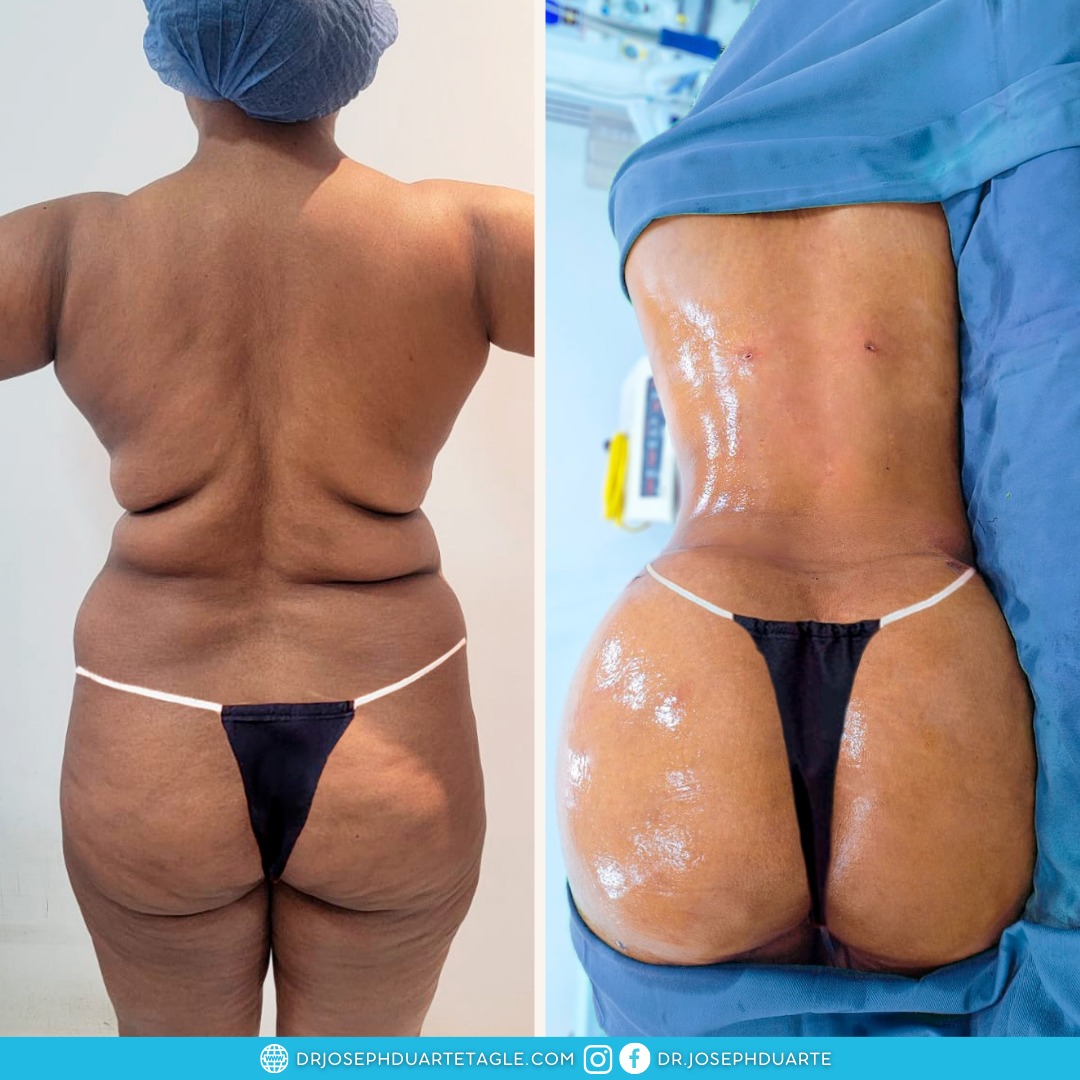 Resultado Lipoescultura y Abdominoplastia Dr. Joseph Duarte