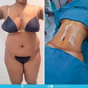Resultado Abdominoplastia Dr. Joseph Duarte