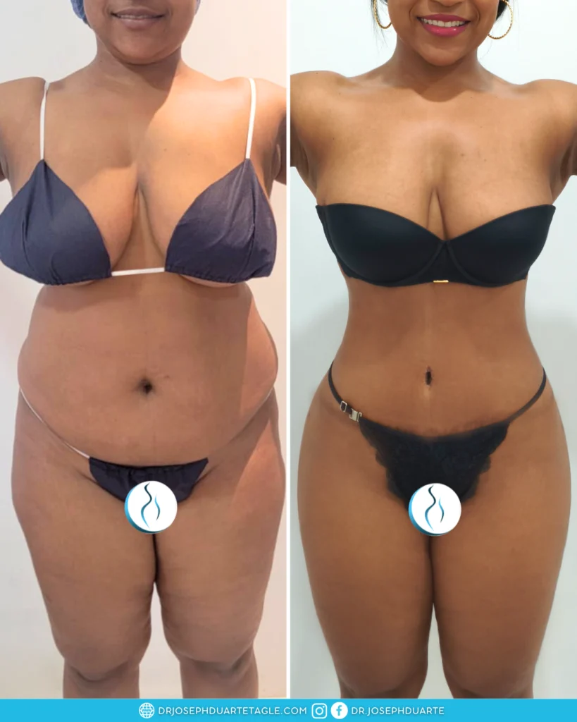 Resultado de paciente con Lipoabdominoplastia Cirugía Plástica y Estética
