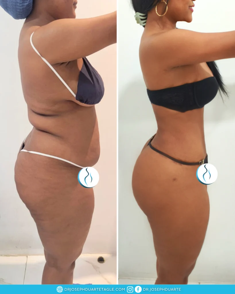 Resultado de paciente con Lipoabdominoplastia Cirugía Plástica y Estética