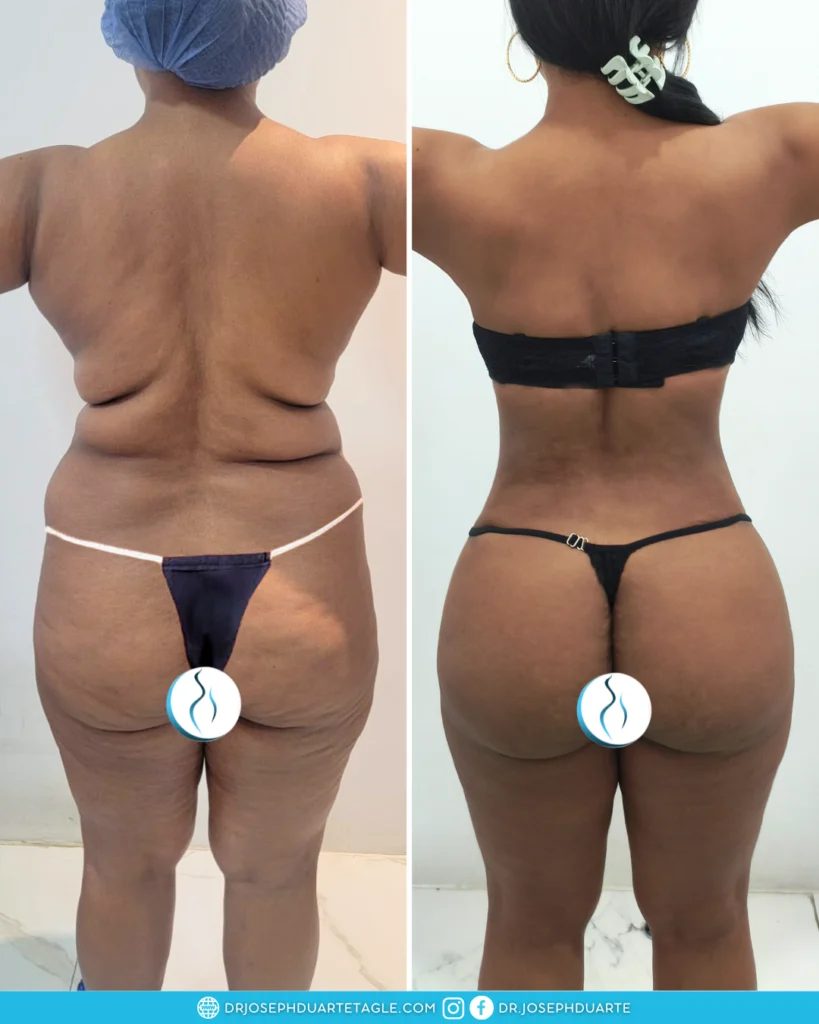 Resultado de paciente con Lipoabdominoplastia Cirugía Plástica y Estética